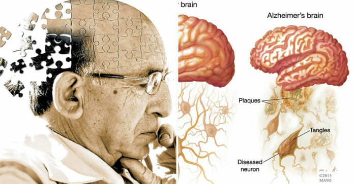 Bệnh mất trí nhớ Alzheimer, 3 cách kiểm tra đơn giản và 10 cách để phòng chống hiệu quả