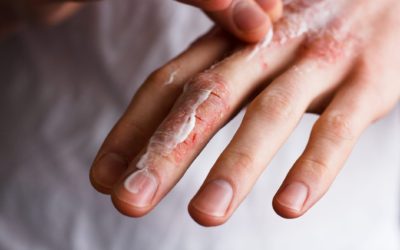 6 Cách chăm sóc da trong mùa đông khô lạnh ở Hàn Quốc: Đừng để da bị nứt toác, rỉ máu & gây đau đớn!